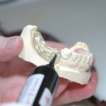 Qué es y cuándo utilizar una prótesis dental sin metal