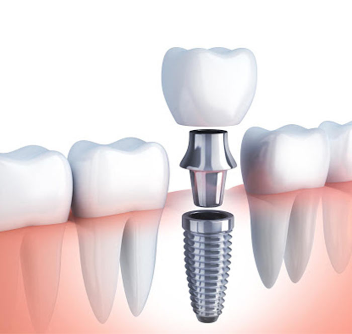 implantes dentale titanio