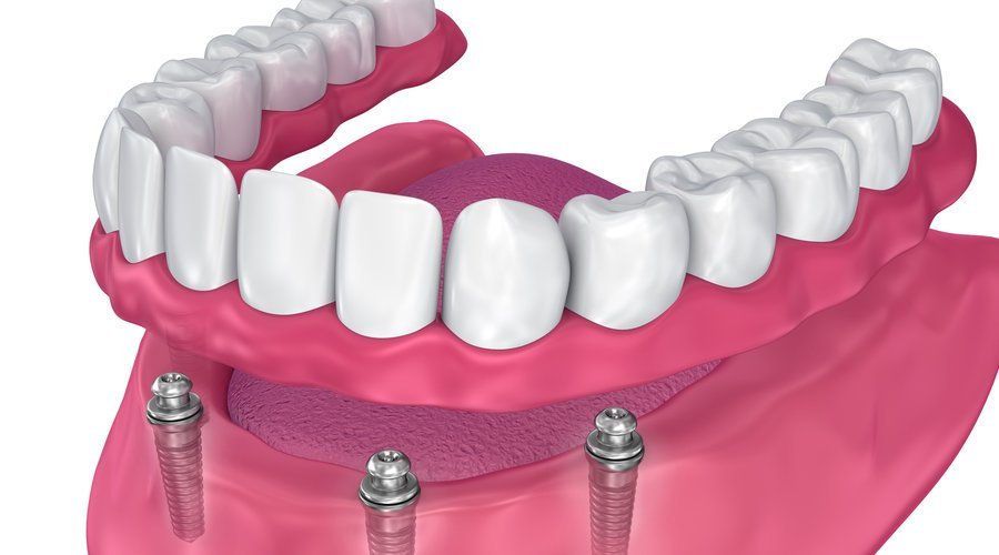 prótesis dental sobre locator