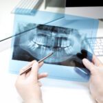 Todo sobre la ortopantomografía